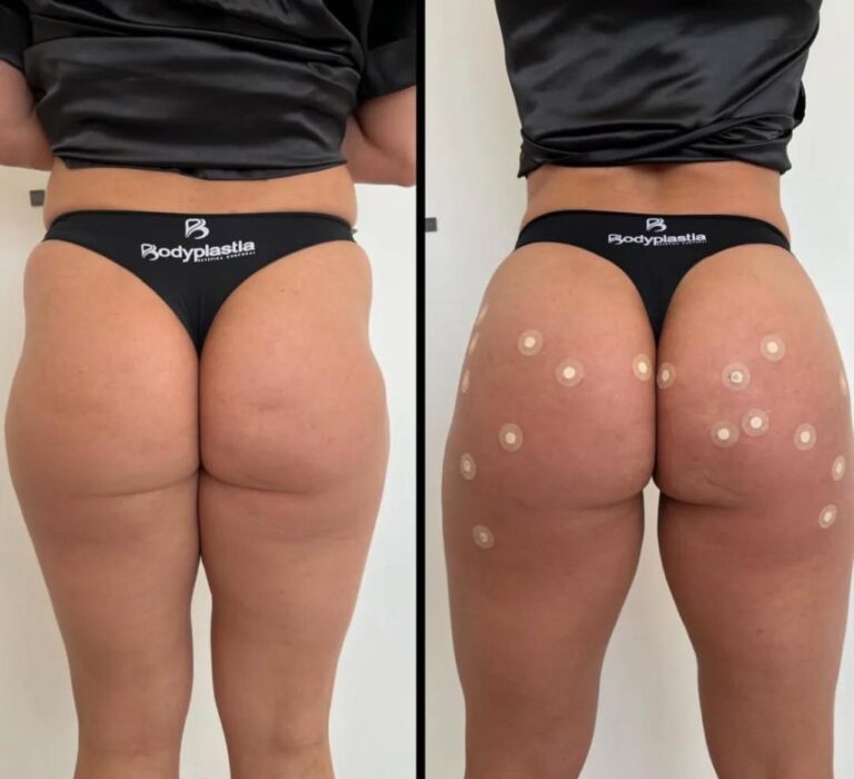 Depressão trocantérica