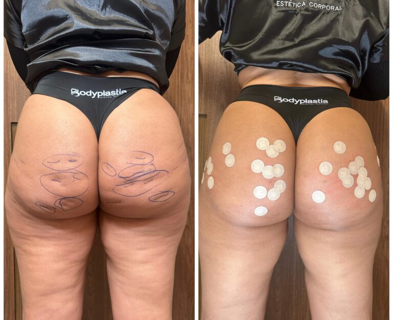 Subcisão de celulites