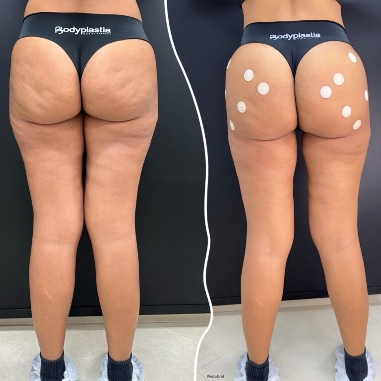 Subcisão de celulites(1)